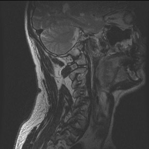 МРТ мягких тканей шеи